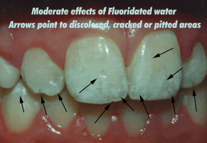 dental+fluorosis.gif